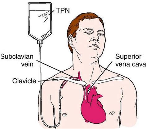 Total Parenteral Nutrition (TPN) .